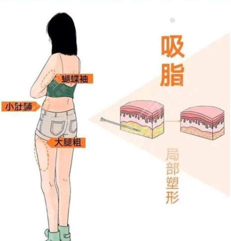 吸脂减肥塑形